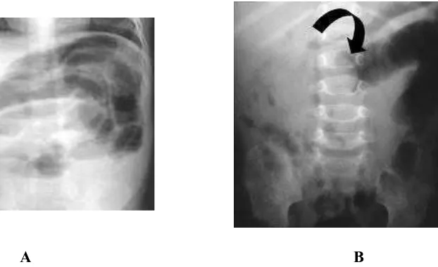 Gambar 2. Foto polos abdomen; A, tampak bayangan massa (tanda panah) merupakan bagian usus yang masuk ke lumen usus proksimal