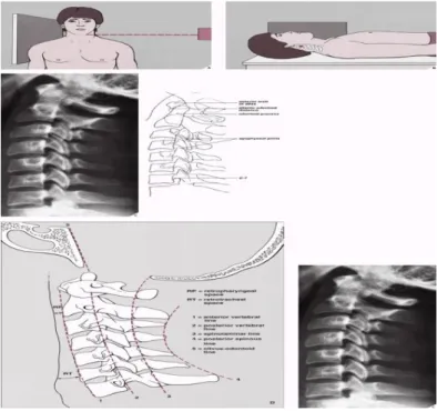 Gambar 3. Penilaian alignment pada radiografi vertebra cervikal posisi lateral  Radioanatomi vertebra 