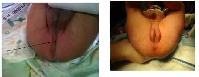 Gambar 1. Bayi Laki-laki Berusia 1 Hari  dengan MAR Fistula Perineal. 8 