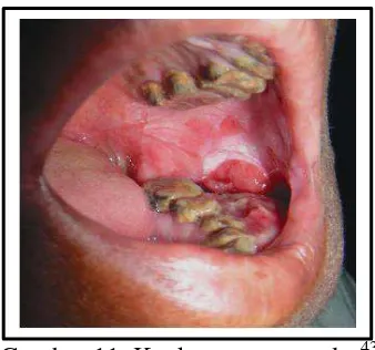 Gambar 11. Kanker rongga mulut43 