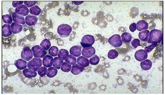 Gambar 2.1. Leukemia Limfoblastik Akut tipe L-1(Roganovic, 2013)  