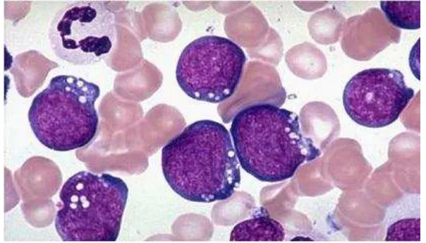 Gambar 2.2. Leukemia Limfoblastik Akut Tipe L-2 (Roganovic, 2013)  
