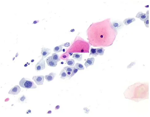 Gambar 2.3 CIN 1 – Low-grade Squamouse Intraepithelial Lesion