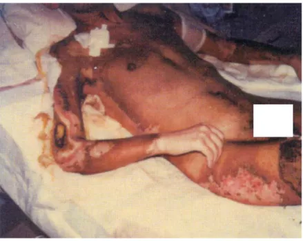 Gambar 2. Kasus SRA yang disertai dengan   sindroma kutaneus pada korban Chernobyl. 