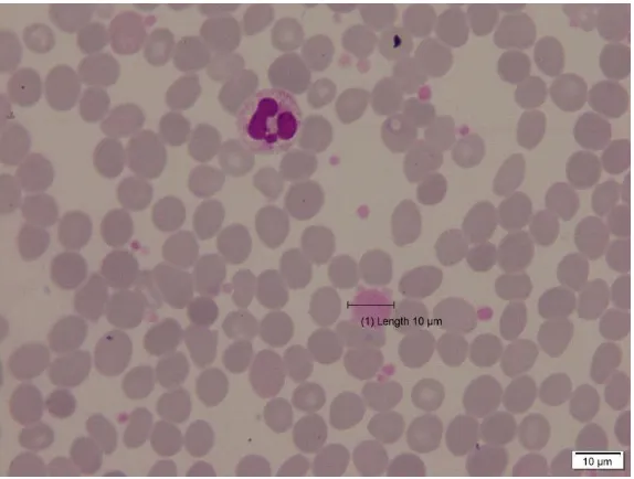 Gambar 2.6 Giant platelet pada pasien primary myelofibrosis (Bain, 2014) 
