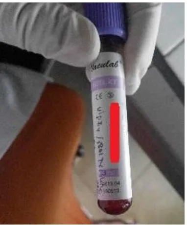 Gambar 3.7 Sampel darah pasien pada vacuum tube EDTA. 