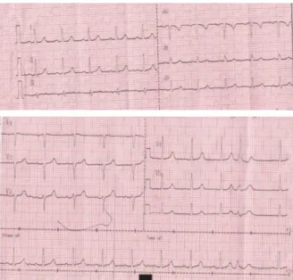 Gambar 1. Hasil EKG pasien saat masuk rumah sakit  