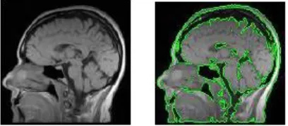 Gambar 2.14 Kiri: Gambar MRI, Kanan: Hasil Segmentasi [11] 