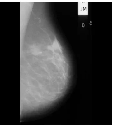 Gambar 2.1. Citra mammogram. 