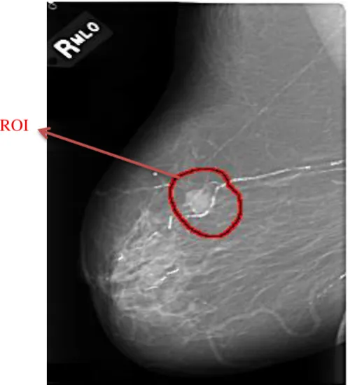 Gambar 3.2 ROI citra mammogram.