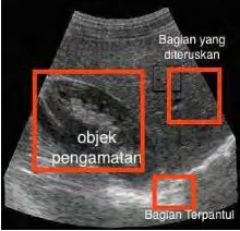Gambar 2.1 Contoh Ilustrasi Ultrasound pada suatu Bagian Tubuh [1] 