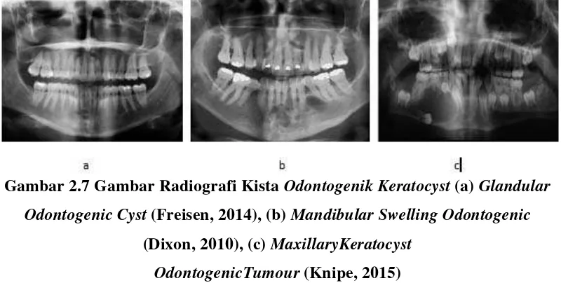 Gambar 2.7 Gambar Radiografi Kista Odontogenik Keratocyst (a) Glandular 