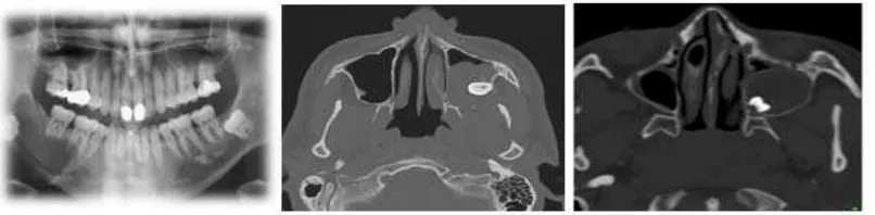 Gambar 2.8 Gambar Radiografi Kista Dentigerous (a) Unilacular Dentigerous 