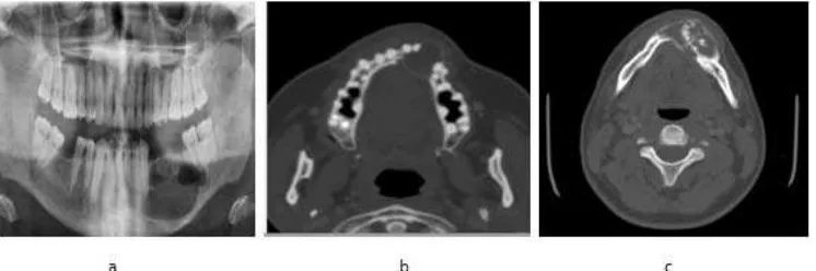 Gambar 2.6 Gambar Radiografi Kista Ameloblastoma (a) Unicystic 