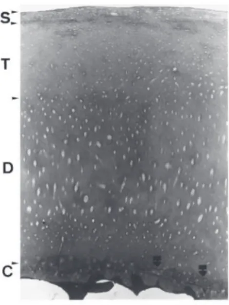Gambar 1.2 Kartilago sendi dengan tanda degenerasi ringan dari kondilus  medial femoralis  (2)