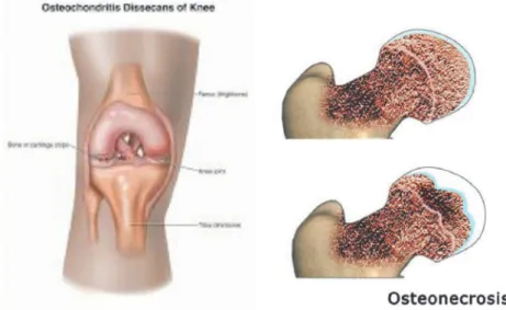 Gambar 2.1 Osteokondritis (a) dan Osteonekrosis(b) merupakan penyebab dari  kerusakan fokal pada kerusakan kartilago