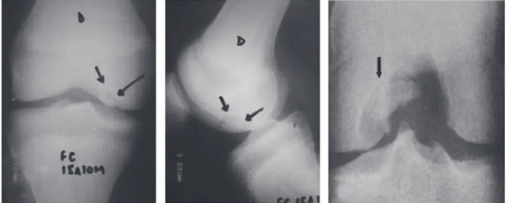 Gambar 3.2 Pemeriksaan radiografi pada lokasi klasik OCD, pada permukaan  posterolateral dari kondilus femoralis