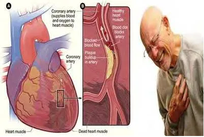 Gambar 2.8:Pembuluh darah jantung yang telah menyempit.Sumber :American Heart Organization