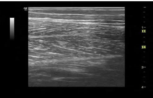 Gambar 3.7 Hasil Citra Ultrasound di kaki   