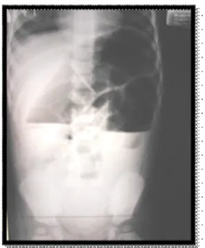 Foto  polos  abdomen  3  posisi  akan ditemukan  tanda-tanda  obstruksi  dengan gambar “air-fluid levels” dan distribusi udara dalam usus tidak merata (gambar 1).