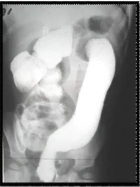 Gambar  2.  Foto  barium  enema.  Tampak cupping  dan  coilspring  pada usus (panah).