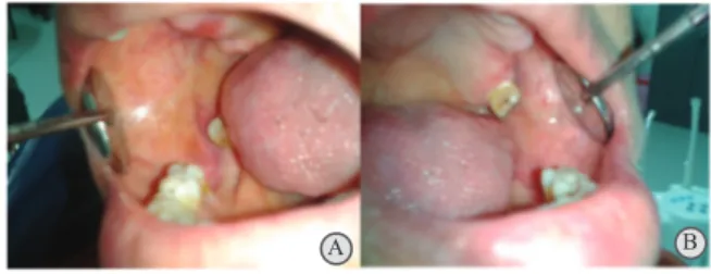 Gambar  4.  Gambaran  klinis  pasien  pada  kunjungan  terakhir   A,B:  Penyembuhan  sudah  terlihat  pada  area  mukosa  bukal   kanan  dan  kiri