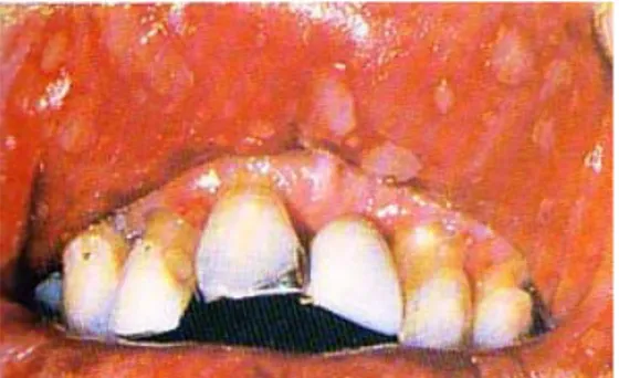 Gambar 3. Aphous Ulcer Herpeticform 