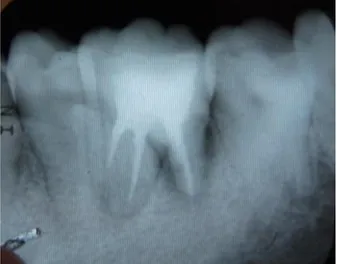 Gambar  5.  Penyembuhan  pada  tulang  alveolar  sebelah  akar  distal gigi