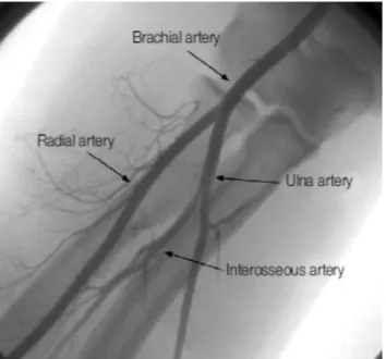 Gambar  2.  Hasil  angiografi  yang  memperlihatkan  perjalanan arteri radialis, arteri ulnaris, dan arteri brakialis  yang normal