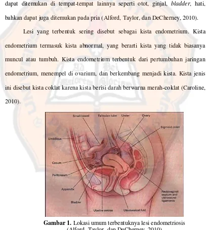 Gambar 1.  Lokasi umum terbentuknya lesi endometriosis 
