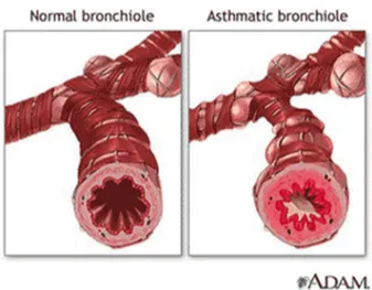 Gambar  2.1  perbedaan  bronkus  normal  dan  bronkus  pada  penyakit  asma 