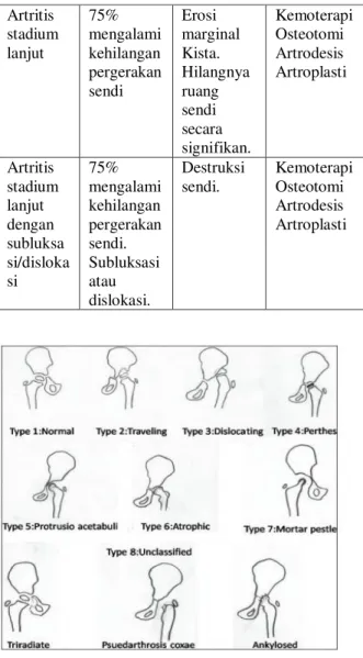 Gambar  11.  Diagram  kelainan  sendi  panggul menurut Shanmugasundara. 13   