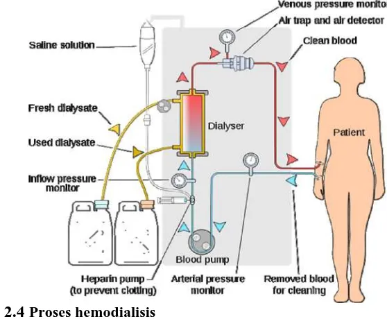 Gambar 2.4 Proses hemodialisis 