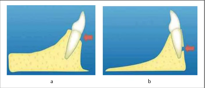 Gambar 2.11.  Fotografi intraoral. a. Pasien  dengan  resesi  gingiva;                            b