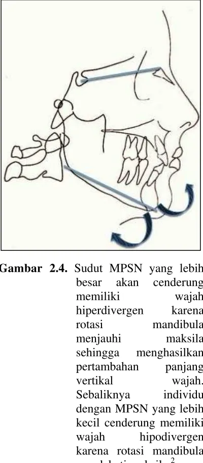 Gambar 2.4. Sudut MPSN yang lebih 