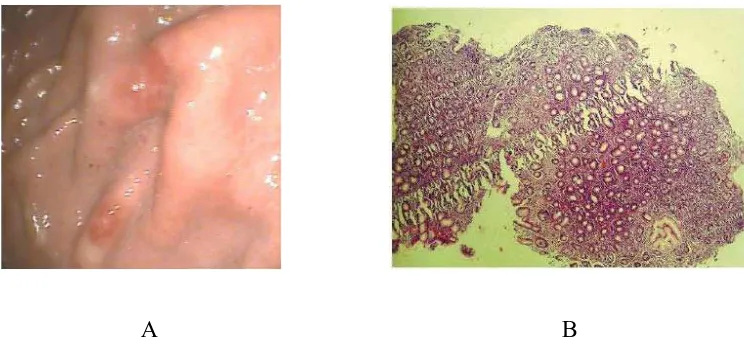 Gambar 2.2. A. Gastritis erosiva (Szoke D, 2009), B. Biopsi gaster menunjukkan erosi epitel permukaan dengan pembesaran 40x (Garg B, et al, 2012)