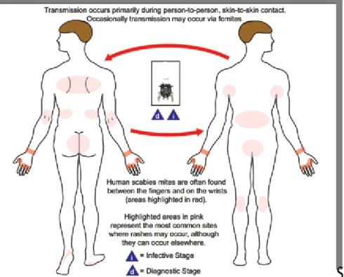 Figura  6:  Ilustração  da  transmissão  direta  do  ácaro  S.  scabiei  e  áreas  do  corpo  mais  frequentemente afetadas (CDC, 2010)