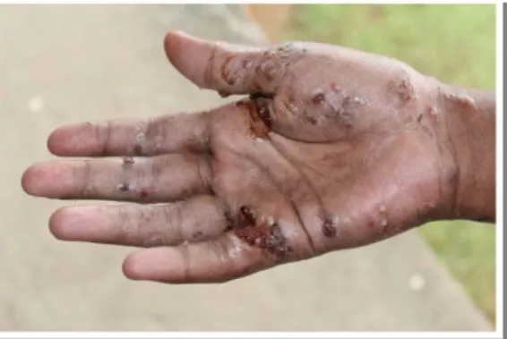 Figura 7: Mão de uma adolescente, em Fiji, com uma infestação de sarna e uma infeção  secundária típica bacteriana concomitante (Engelman et al., 2013).