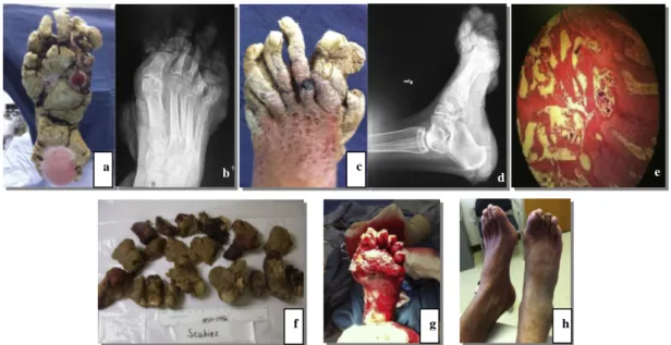 Figura 10: Observação da zona plantar do pé direito (a) e respetiva radiografia (b), da  zona dorsal do pé esquerdo (c) e respetiva radiografia lateral (d); análise microscópica  do  ácaro  da  escabiose  humana  (e),  amostras  recolhidas  (f)  e  vista  