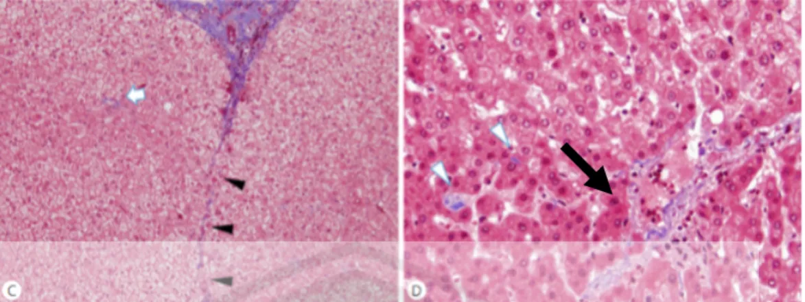 Gambar  2.8.  Jaringan  Fibrosa  Pada  Hepar.  Keterangan:  (C)  kepala  panah  hitam  =  jaringan  kolagen  di  saluran  portal,  (D)  panah  hitam:  jaringan  fibrosa