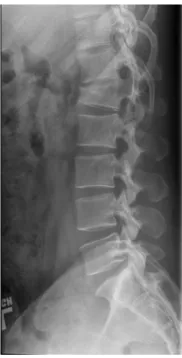 Gambar 2.3. Gambaran radiologis fraktur kompresi vertebra akibat osteoporosis. (Gambar diambil dari www.osteoporosistreatment.link) 