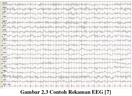 Gambar 2.3 Contoh Rekaman EEG [7] 