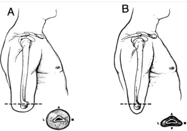 Gambar 1. 4. (kiri) prostetik untuk disartikulasi siku, (kanan) prostetik untuk pasien amputasi transradial (Atlas of Limb Prosthetics: Surgical, Prosthetic, and Rehabilitation Principles) 