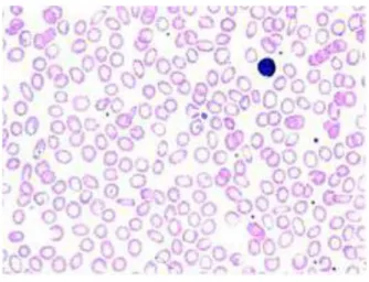 Gambar 1. Contoh gambaran sel darah merah pada pasien thalasemia. 15