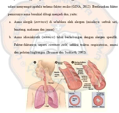 Gambar 1. Definisi asma (NIH, 2012) 