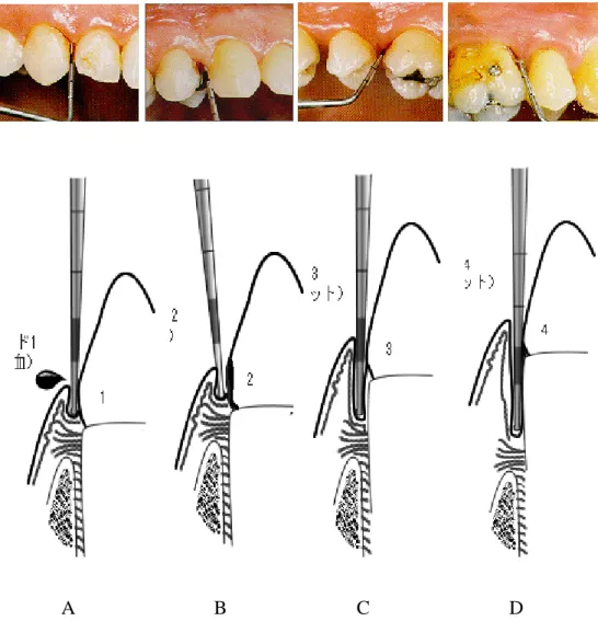 Gambar 1. Pemberian skor status periodontal. A : gusi berdarah; B : karang gigi; C  : poket 4-5 mm; D : poket diatas 6 mm (Oliver, Brown, 2000) 