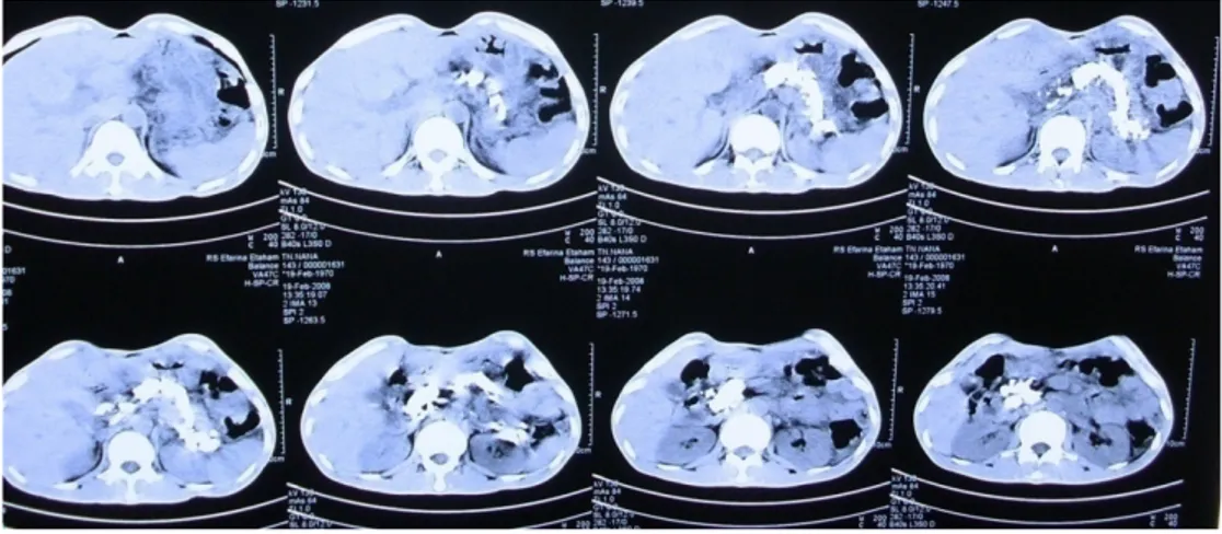 Gambar 3. CT-scan : pankreas tampak membesar, tekstur parenkim kabur dengan  batas irreguler, tampak kalsifikasi mulai kaput, korpus sampai kauda pankreas