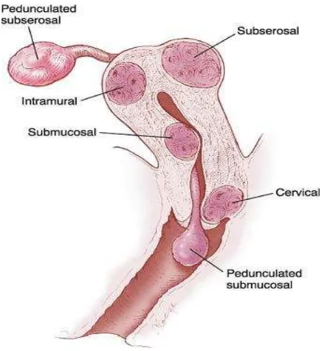 Gambar 2.1 Leiomioma uterus pada berbagai lokasi anatomis 