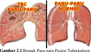 Gambar 2.1 Bentuk Paru-paru Pasien Tuberkulosis 