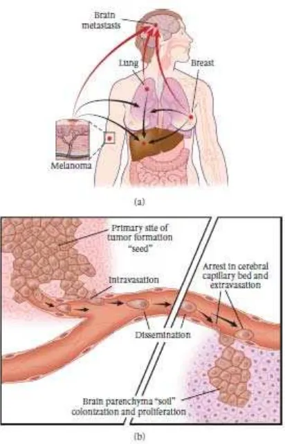 Gambar 1. Skema Proses Metastasis. (a) Pembentukan sel tumor metastasi pada asal tumor primer (b) Sel tumor metastase lepas dari tumor primer kemudian masuk ke pembuluh darah